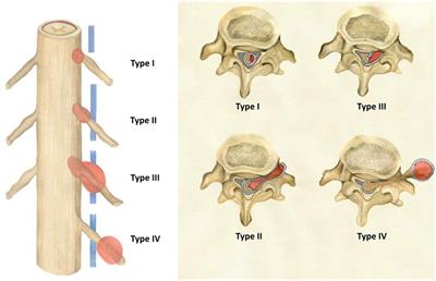 Non-Syndromic Spinal Schwannomas: A Novel Classification